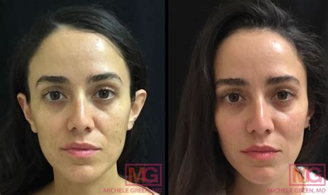 Juvederm Dermal Fillers For Smile Lines Dr Michele Green Md