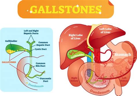 Gallbladder Surgery Removal In Singapore Costs Procedure