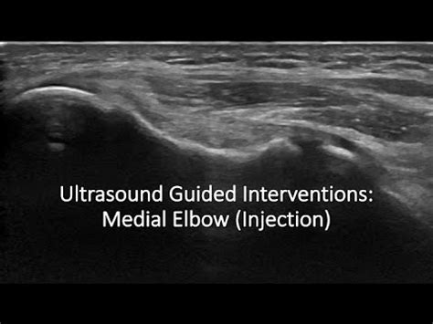 Ulrasound Guided Interventions Medial Elbow Injection Ultrasound