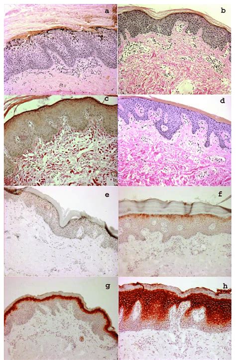 Histopathologic abnormalities in various types of congenital ichthyosis ...