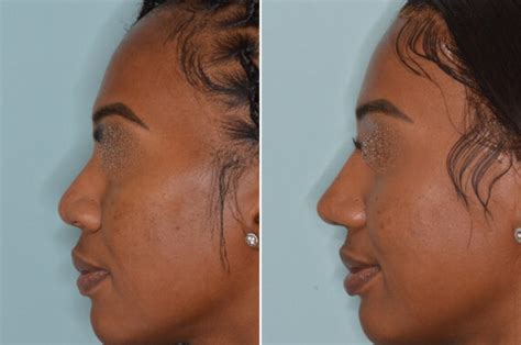 The Cost Of Rhinoplasty In Miami Dr Bared