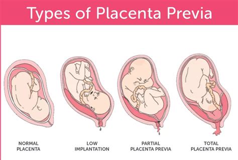 Lets Talk About Antepartum Hemorrhage Platform Cme