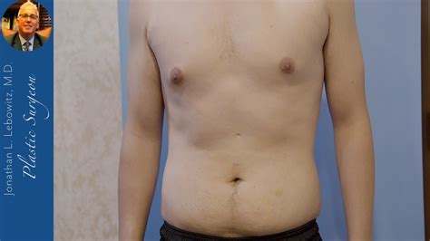 Understanding The Difference Between Gynecomastia And Fat How To Tell