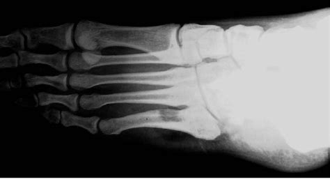 Figure 3 From Osteoid Osteoma At The Proximal Diaphysis Of The Fifth