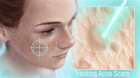 Regaining Confidence With Acne Scar Treatment Dermatology