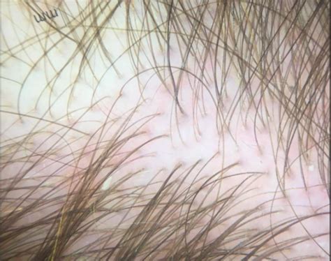 Female Androgenetic Alopecia — Donovan Hair Clinic