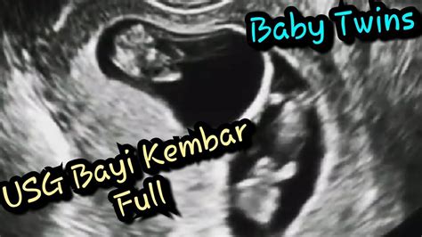 Usg Kehamilan Bayi Kembar Minggu Full Baby Twins Ultrasound