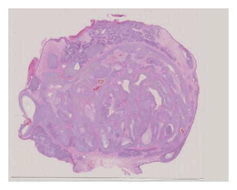 Clinical Manifestation And Histopathology A A Polypoid Nodule Was