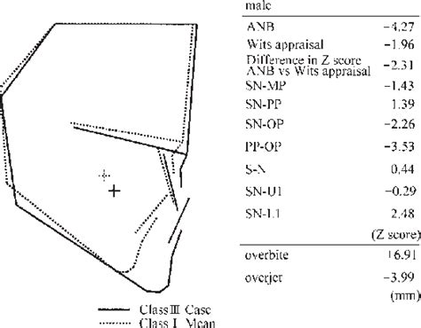 Figure 1 From Properties Of The Anb Angle And The Wits Appraisal In The Skeletal Estimation Of