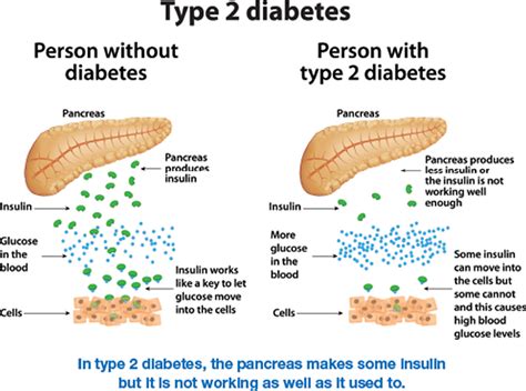 Type 2 Diabetes Causes Symptoms Complications Diagnosis And Treatment