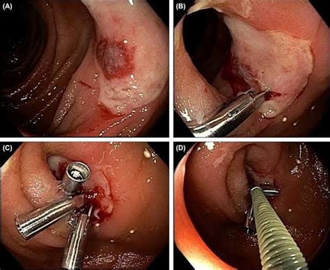 Management Of Rectal Bleeding MEDizzy