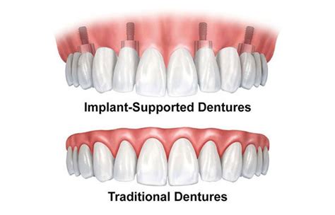 Alternatives to Dentures | Dr. John F. Rink