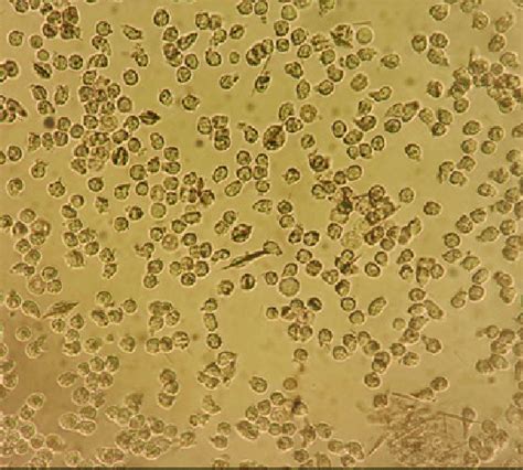 Intracellular Monosodium Urate Crystals Non Polarized Light Microscopy