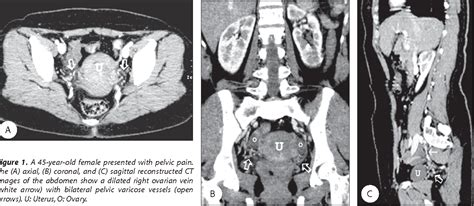 Figure 1 From Multi Detector Row Computed Tomography Findings Of Pelvic