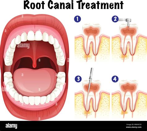 Dental Vector Of Root Canal Treatment Illustration Stock Vector Image