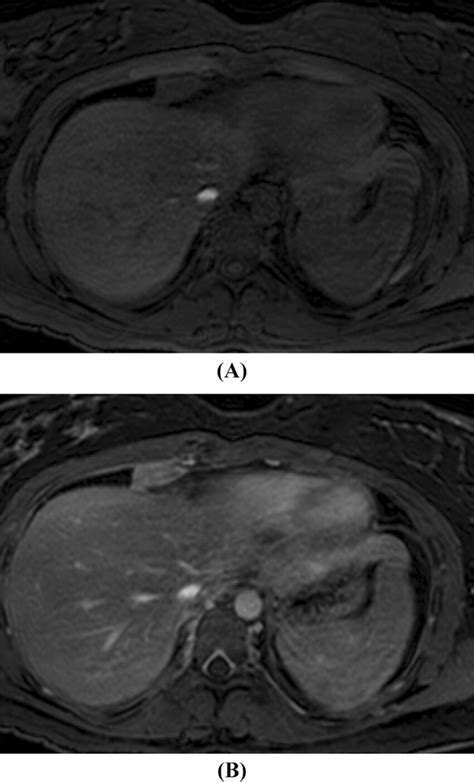 A Pre Contrast Axial T Weighted And B Post Contrast Axial T Weighted