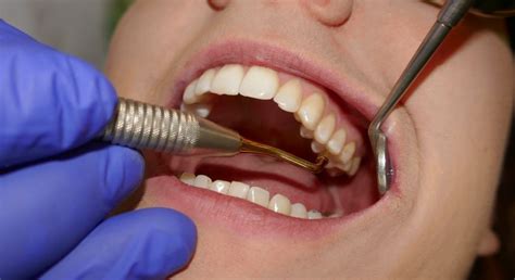 Numbing Gel Teeth Cleaning