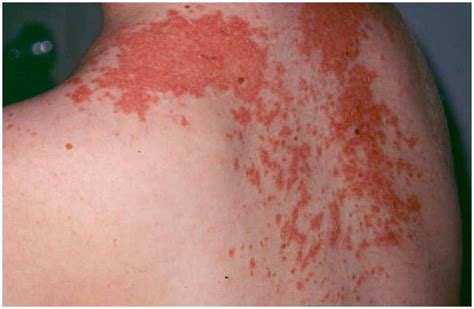 Maculopapular Rash - Causes, Symptoms, Treatment, Pictures, Diagnosis | Diseases Pictures