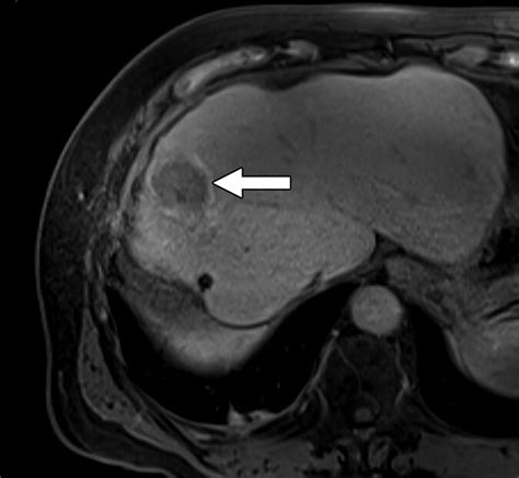 A Review Of The Spectrum Of Imaging Manifestations Of Epithelioid