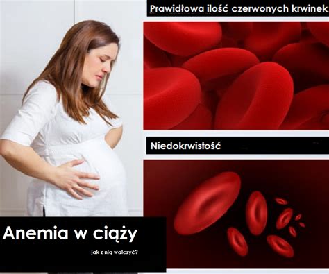 Anemia W Ci Y Przyczyny Objawy I Leczenie E Szkrab Pl