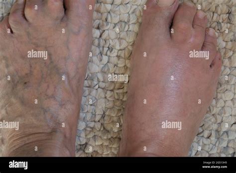 Cellulitis Foot