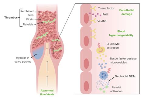 Deep Vein Thrombosis Concise Medical Knowledge