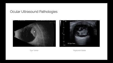 Ocular Ultrasound Ultrasound In Ophthalmology Youtube