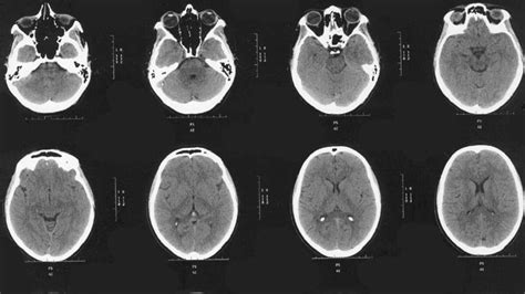 Scanner C R Bral Avec Ou Sans Injection D Finition D Roulement Et