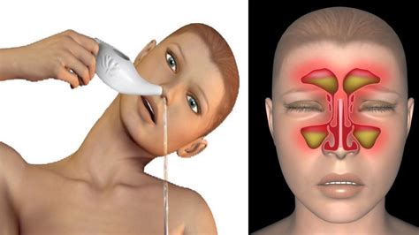 How To Relieve Allergy Sinus Pressure