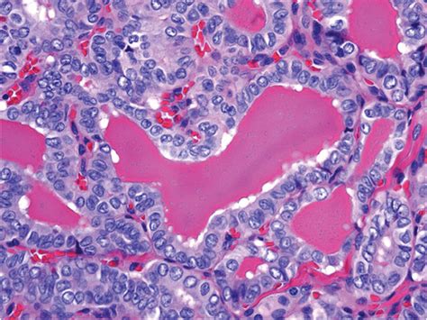 Surgical Pathology Of Thyroid Gland Demonstrating Papillary Thyroid Download Scientific Diagram