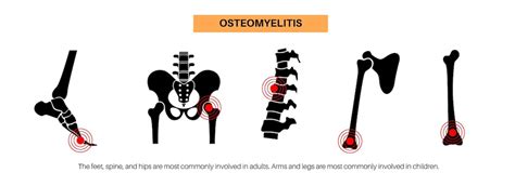 Enfermedad De Osteomielitis Casos Comunes Huesos Infectados De La