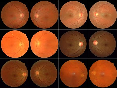 Figure 1 From Improved Automated Detection Of Diabetic Retinopathy On A Publicly Available