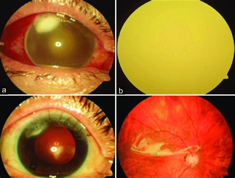 Case Of Corneal Abscess A And Endophthalmitis B Followed By Download Scientific Diagram