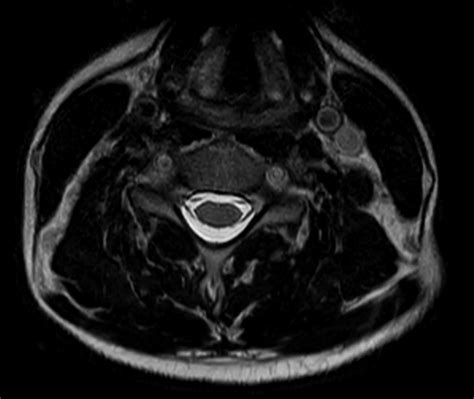 Comprehensive Cervical Spine Imaging At 1 5t Philips Mr Body Map