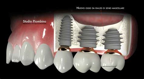 Grande Rialzo Del Seno Mascellare Sinus Lift Studio Piombino Caserta