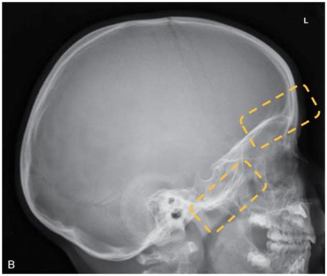 Cranium Lateral Projection Eval Criteria Flashcards Quizlet