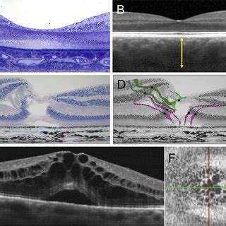 Morphology of the macula in physiological conditions and with edema. A.... | Download Scientific ...