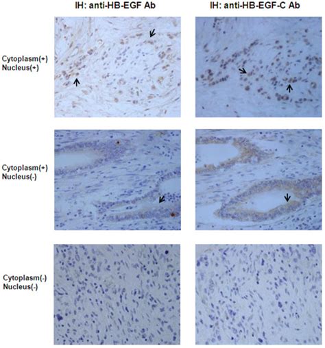 Immunohistochemistry In Human Gastric Cancer Heparin Binding Epidermal