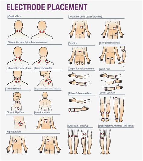 Electrode Placement Chart For Tens Unit