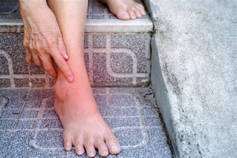 Common Causes of Drop Foot | Drop Foot Treatment | Drop Foot Care