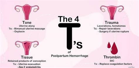 Postpartum Hemorrhage Pph Part Thisdaylive