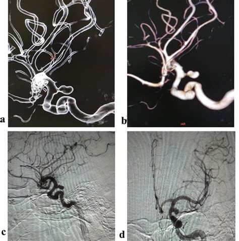 Cerebral Angiograms Aneurysm Of The Left Ica A And B D Models