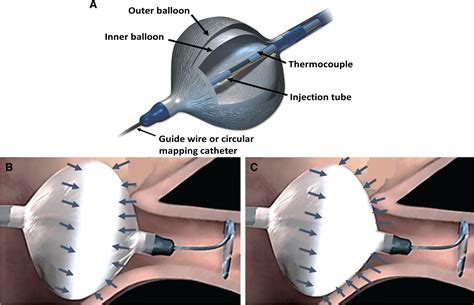 Cryoballoon Ablation Of Atrial Fibrillation A Practical And Effective Approach Georgiopoulos