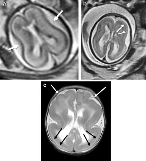 Lissencephaly A Axial T2 W Single Shot Fast Spin Echo SSFSE Fetal MR