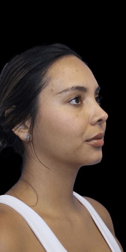 Patient Primary Rhinoplasty Before And After Photos Miami Fl