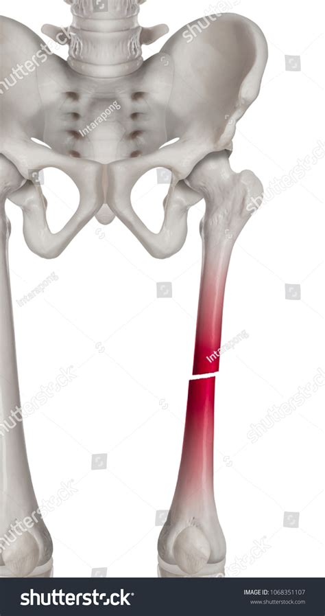 4,075 Human thigh bone Images, Stock Photos & Vectors | Shutterstock