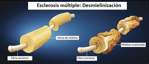 Esclerosis Múltiple Qué Es Causas Y Síntomas Tu Canal De Salud