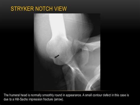 Radiographic Evaluation Of Shoulder