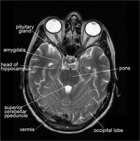 Axial Anatomy Brain Brain Anatomy Radiology Mri Brain