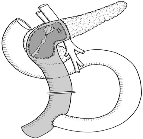 Berne Procedure Intervention Reconstruction After Duodenum Download Scientific Diagram